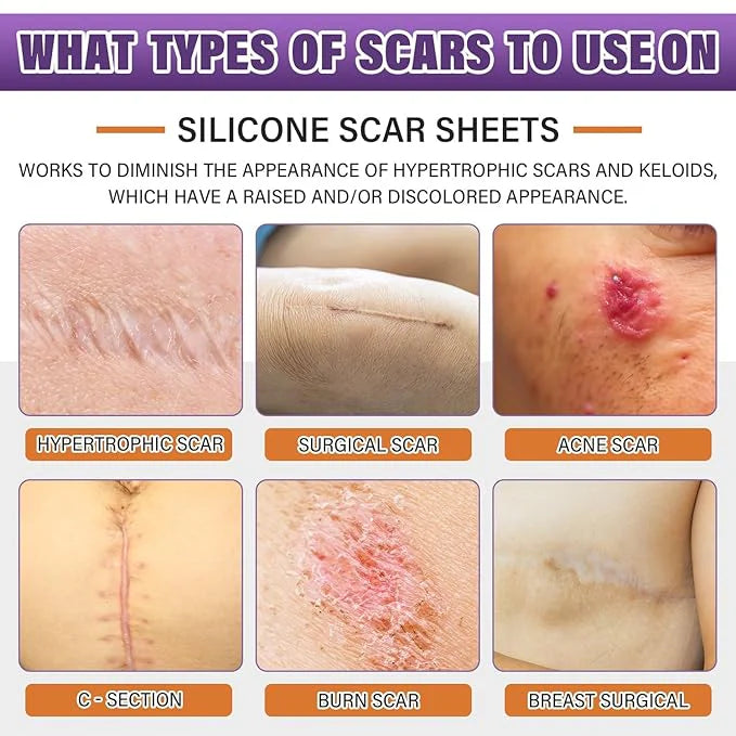 Silicone Scar Sheets, Silicon gel sheets for Scars Transparent Medical Silicone Gel Tape